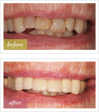 before and after dental crowns treatment